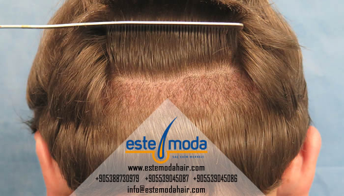 Is Hair Transplant Successful In India