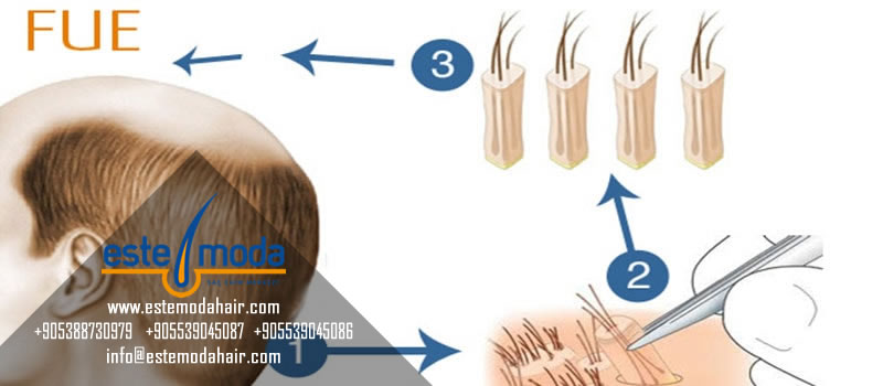Hair Transplant Between Existing Hairs