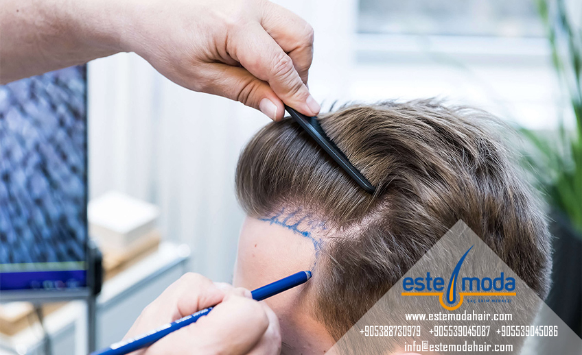 Which Hair Transplant Clinic In Turkey