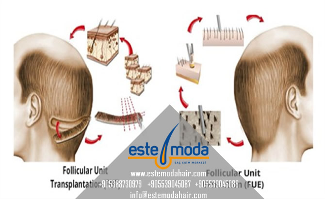 Hair Transplant Young Age