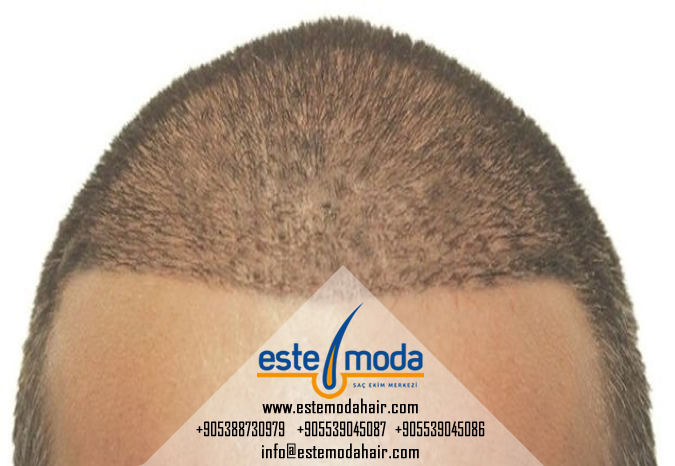 Hair Transplant Before And After India