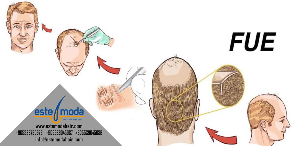How Hair Transplant Is Done Video