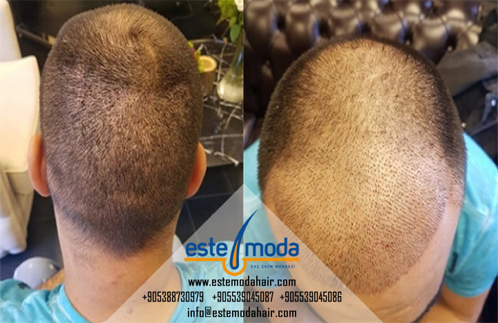 Hair Transplant 800 Grafts Before And After