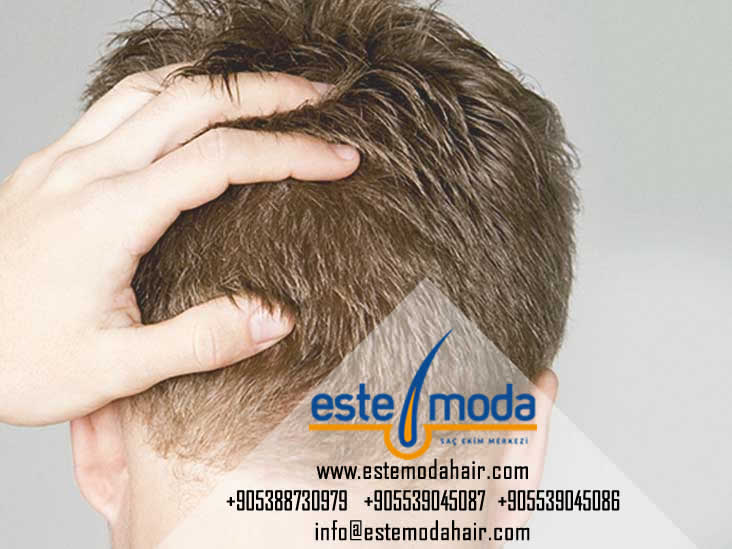 Why Hair Transplant In Pune