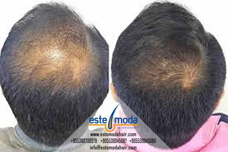 Hair Transplant Touch Up