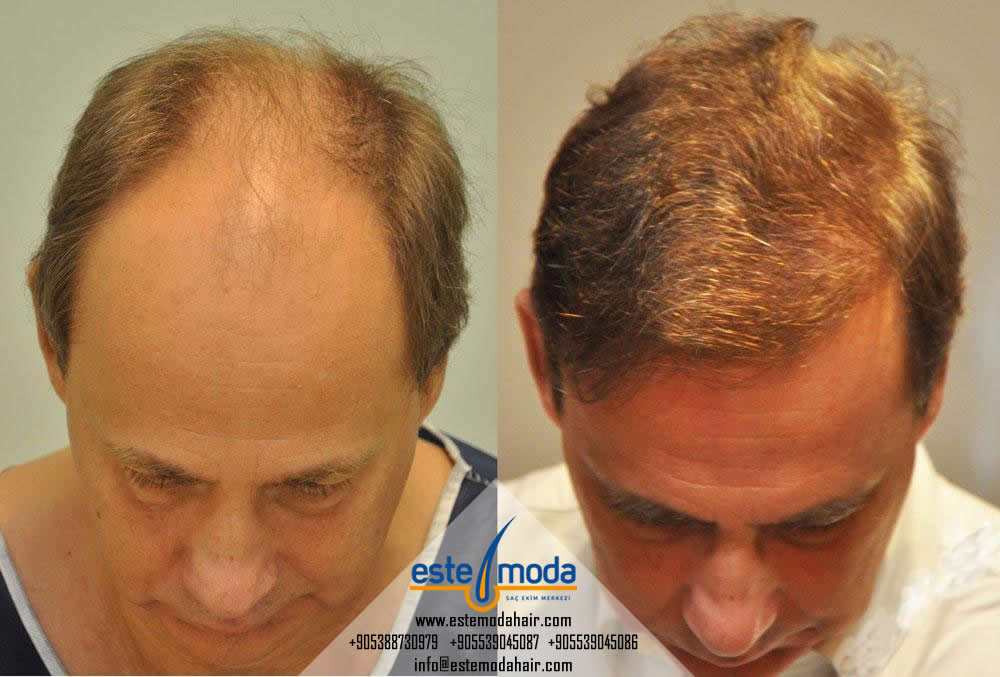 Can Hair Transplant Reduce Forehead