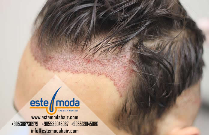 How Hair Transplant Cost