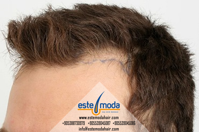 Hair Transplant Touch Up Free